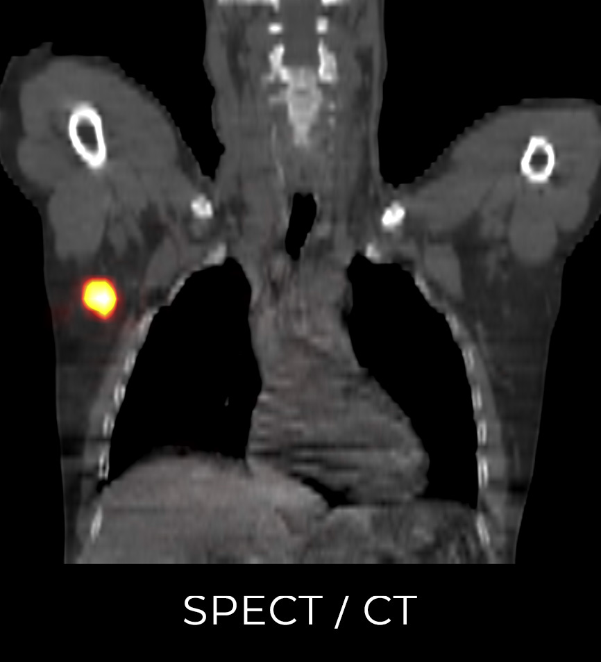 SPECT and CT